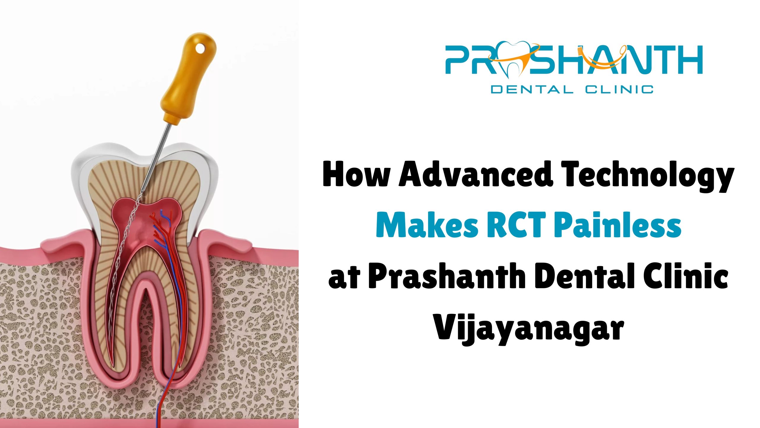 Painless Root Canal Treatment in Vijayanagar | Advanced RCT Technology – Prashanth Dental Clinic