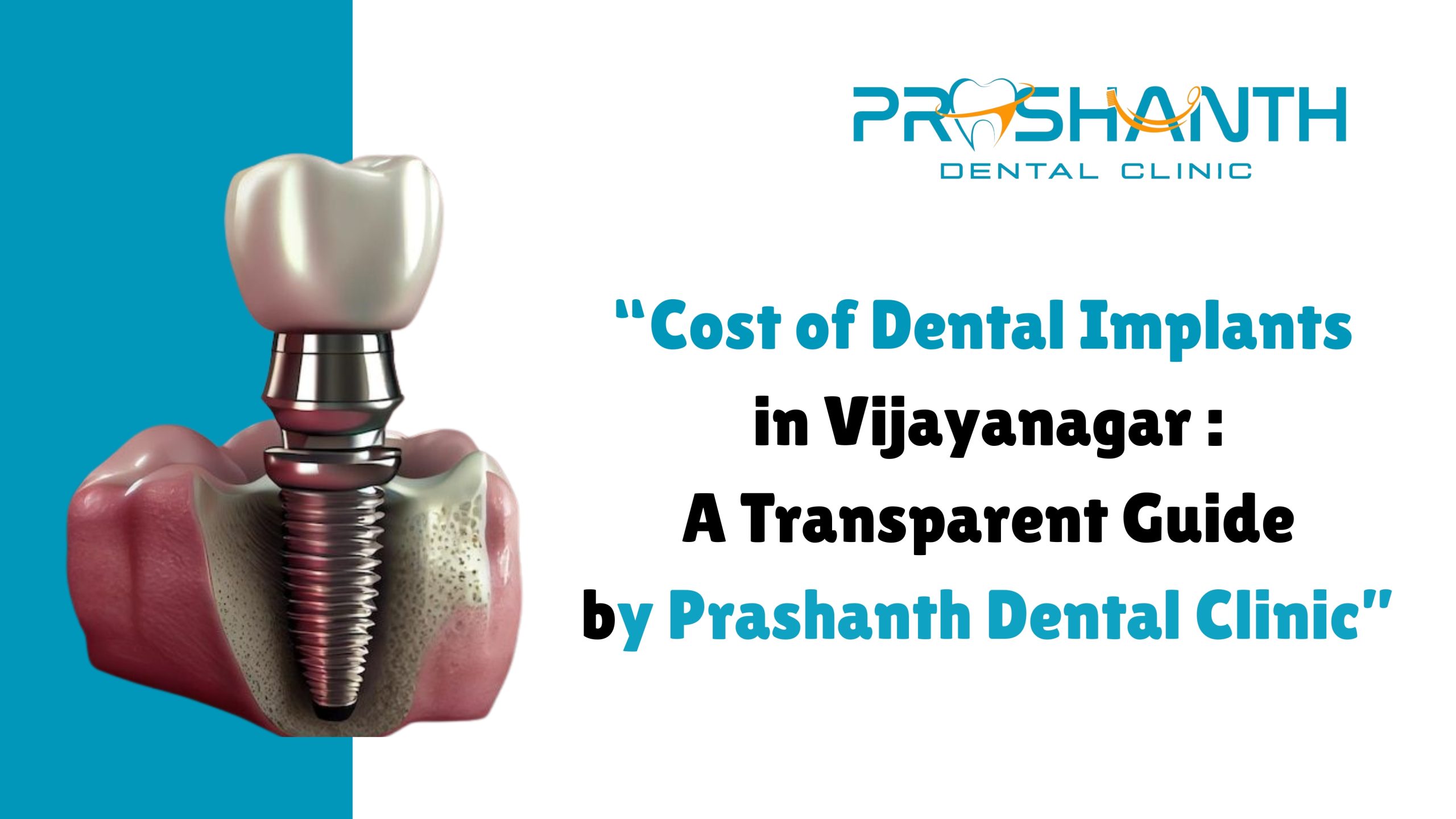 Cost of Dental Implants in Vijayanagar: A Transparent Guide by Prashanth Dental Clinic