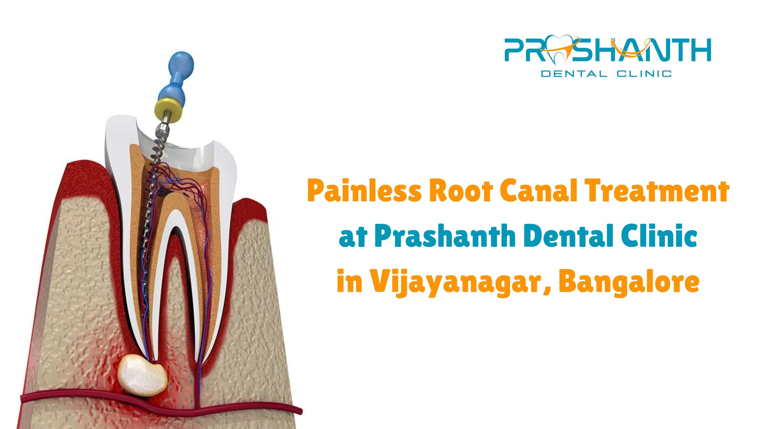 Painless Root Canal Treatment in Vijayanagar, Bangalore | Prashanth Dental Clinic